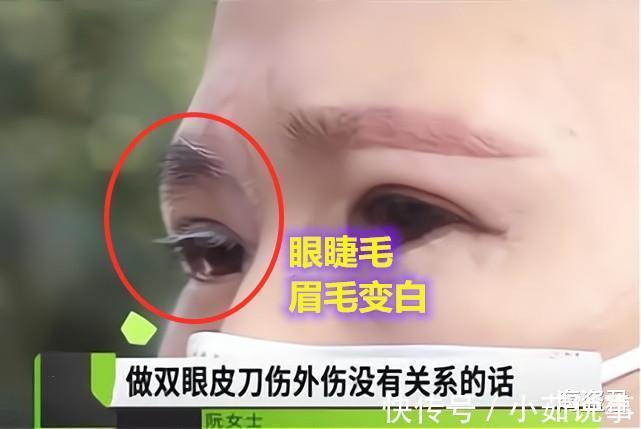 爱美之心 女子割双眼皮后变“白眉大侠”，找美容院讨要说法是手术造成的