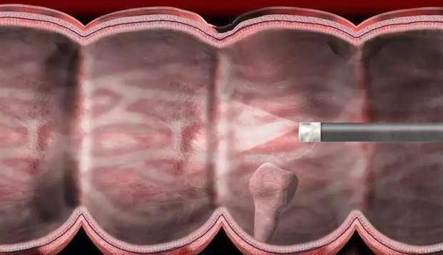 泻药|终于找到便秘的元凶了，预防大肠癌，三种食物最好多吃一点