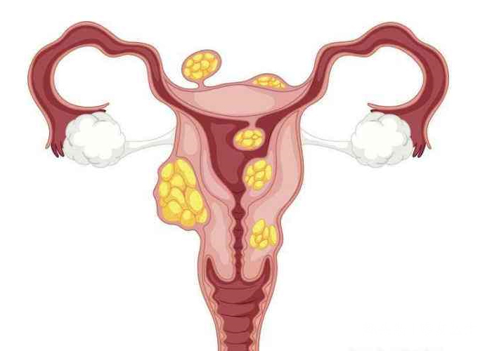 子宫肌瘤|子宫肌瘤发展到什么程度需要治出现3个典型症状，要抓紧治