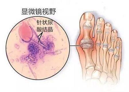 血尿酸|什么是痛风?以下教你如何在日常生活中预防痛风!