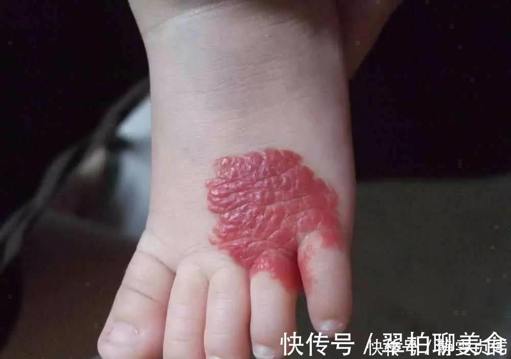 小女孩|那个脸上有“蝙蝠”胎记的女孩,如今生活的怎么样?看完很欣慰