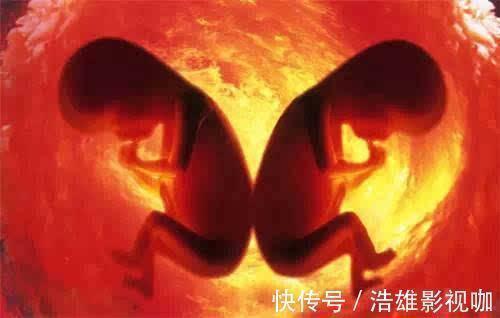 宝宝|最美胎记!双胞胎姐姐“消失”在腹中,化为胎记印在弟弟腿上
