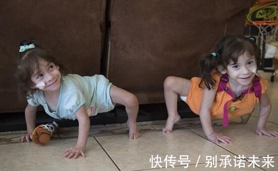 姐妹花 这对连体姐妹花,手术成功分离,每人拥有一条腿,未来的路很艰难