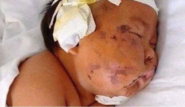 大花脸|产后抑郁多可怕?妈妈用剪刀把孩子划成“大花脸”,现恢复得很好