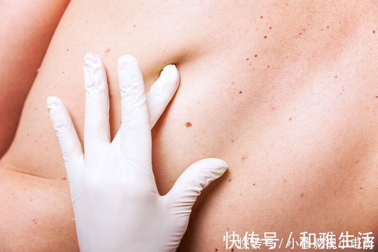 预防肝硬化|重视:除了皮肤小红点,身体出现4个异常,可能是肝硬化“敲门”