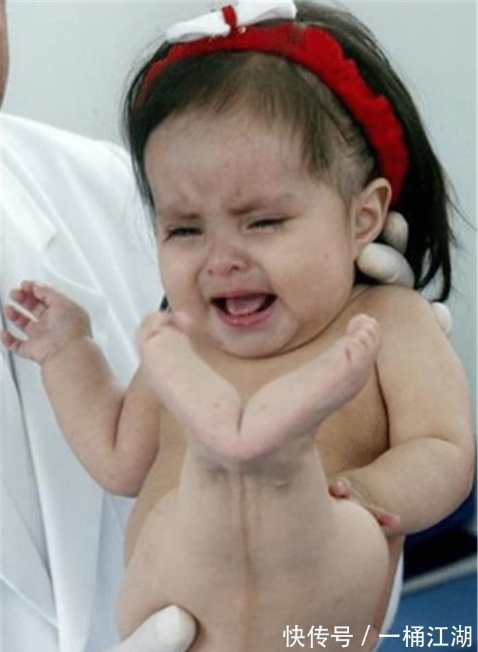 双腿|美国女孩出生患美人鱼症,喜欢在水里,生存十年创造医学奇迹