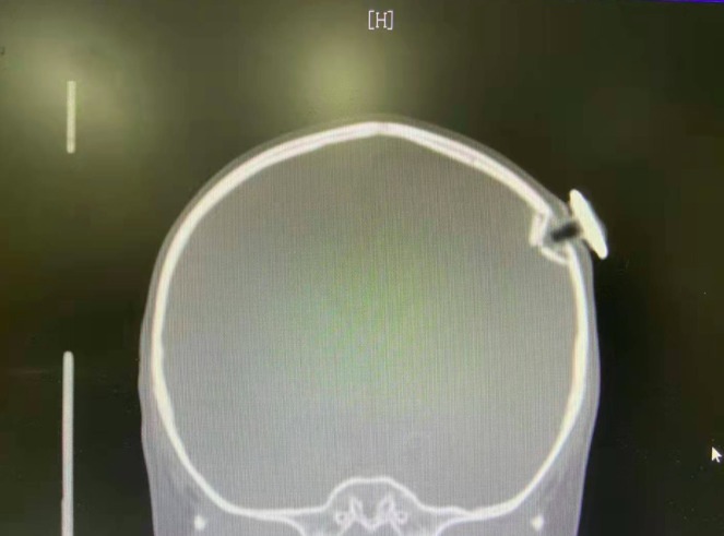 凹陷性骨折|3岁女童一跤摔进ICU,撞碎颅骨、刺破脑膜