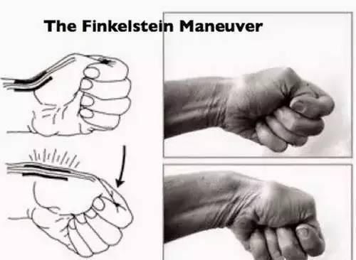 新手妈妈|提重物、抱孩子,手腕疼痛难忍?警惕,小心已患上“妈妈手”!