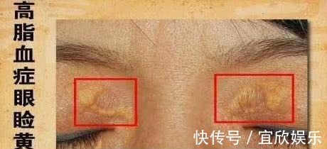 高脂血症|血脂高的人,眼睛可能有3个症状,若没有,说明血脂控制的还不错