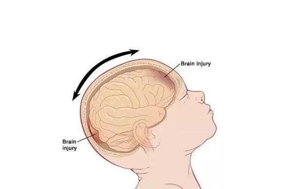 婴儿|婴儿突发脑出血,医生揭露了罪魁祸首,很多父母都在犯!