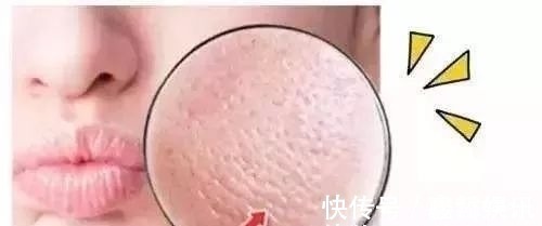 角质 小心!以下5个护肤坏习惯,能让你的毛孔越来越大……