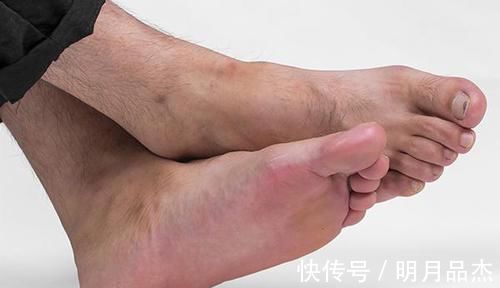 糖尿病|糖尿病患者应警惕并发症，出现3个异常，或是糖尿病足在“接近”