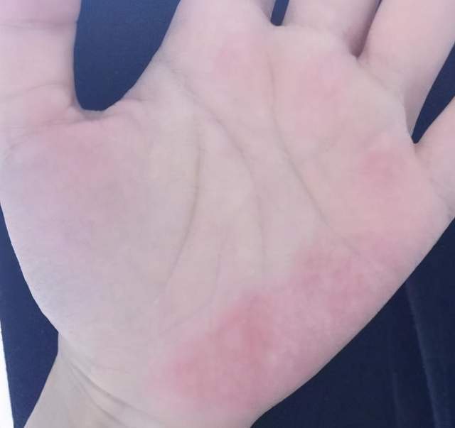 肝脏|肝脏不好的人,会出现2处黑,2处红,一个不占,说明肝比较健康