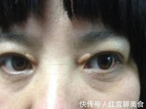 许大姐|血脂升高有哪些变现？若想降脂，学会这“1招”，或让血脂慢慢降