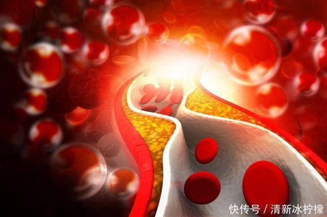 手掌上的这些信号预示血栓,如果不注意当心引发心梗