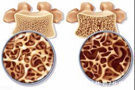 骨质疏松|生完孩子腰酸背痛，万万没想到是这个原因……