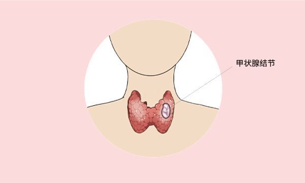 营养物质|长了甲状腺结节,还能不能吃海鲜了?除了饮食,还有三点也要注意