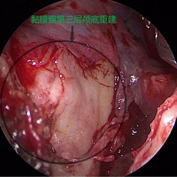 鼻内镜|流“鼻涕”一个多月,竟是脑脊液!鼻内镜下脑脊液修补术解难题