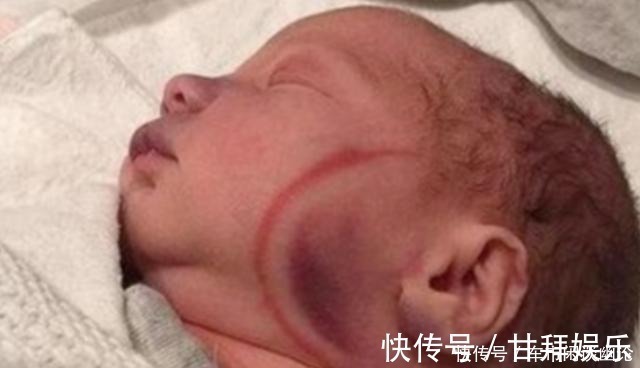 恢复期|剖腹产划伤宝宝脸颊,医生安慰“问题不大”,2个月后父母找说法