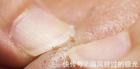 泡沫|看到黑头就想挤担心越挤越多!网上3种方法才损伤皮肤,要避开