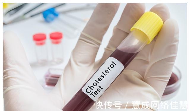 甘油三酯|不吃药,真能降血脂吗?医生确认了:能!但要认准这2种高血脂