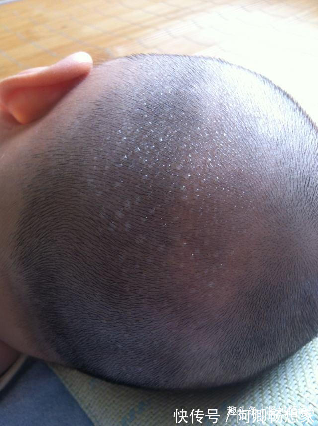 奶粉|孩子睡觉时头上总出汗,是缺钙吗别着急补钙,搞清原因巧护理