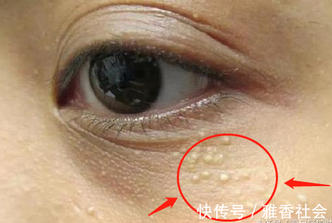 血脂升高|血脂高不高,看脸就知道脸上如果有4个表现,可能要降血脂了