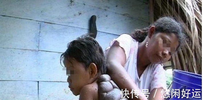 龟壳|奇闻:男孩背上长龟壳,父亲要扔掉,治疗后成这个模样