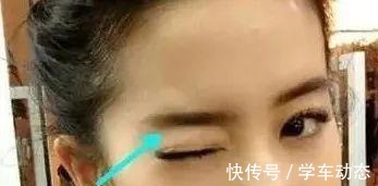 眉骨处 医美避坑理性变美,五大理由拒绝假体眉弓骨!