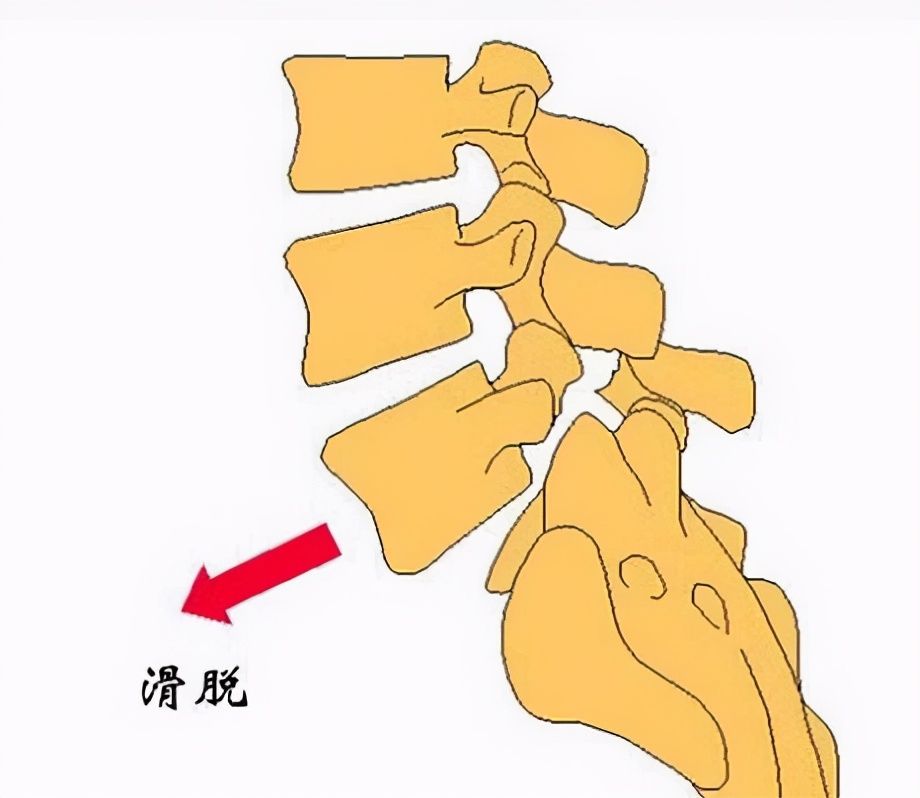 手术治疗|路医生说丨“腰椎滑脱”，究竟是个什么鬼，是腰椎脱位了么？