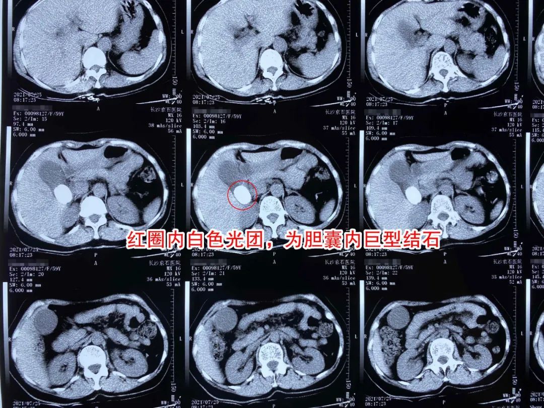梁女士|女子连续半个多月胸背胀痛,检查胆囊后吓一跳