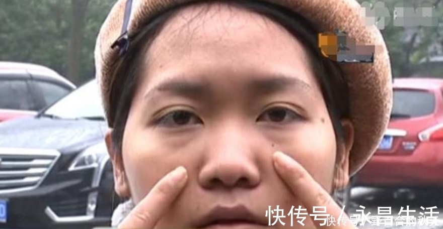 太阳穴|瘦脸后被同事说老了,女子找整形医院退钱,医生:每个人底子不同
