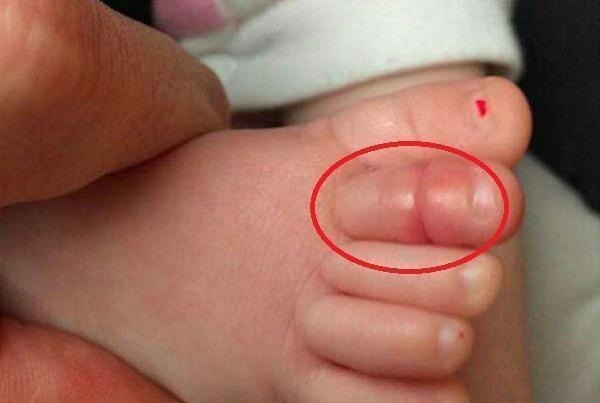 脚趾|11月龄宝宝脚趾进“虫”,家长紧急送医,医生直言幸好来得早