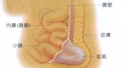 疝囊|疝气不善，家有老人的要注意了