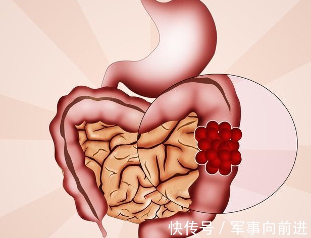 阿姨|45岁阿姨便秘半年，一查是肠癌晚期，身体出现3个症状，要小心