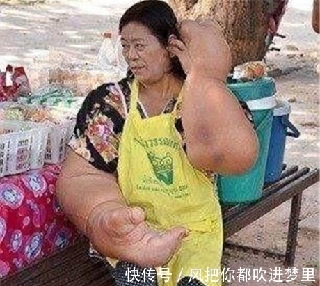 脂肪|女子手臂比大腿还粗,手臂上的脂肪切除掉还是会长出来