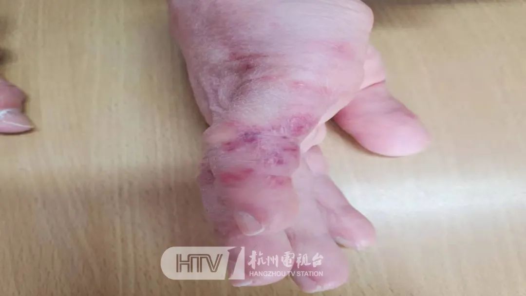 杭州市第一人民医院|杭州4岁男孩冻得满脸红疹，不是冻疮……这种病，这些人留意→