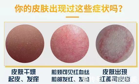 医美 你是敏感肌吗?敏感肌适合做什么医美项目? 如何做好日常护理?