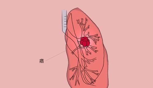 肺癌|女子肺癌7年，两次发生转移，都死里逃生，她的抗癌方法值得学习