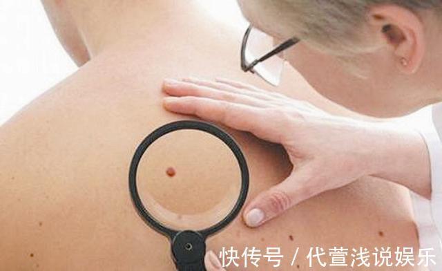 胎记|要想宝宝出生后不长胎记,孕期避免这几件事就OK,你做到了几条