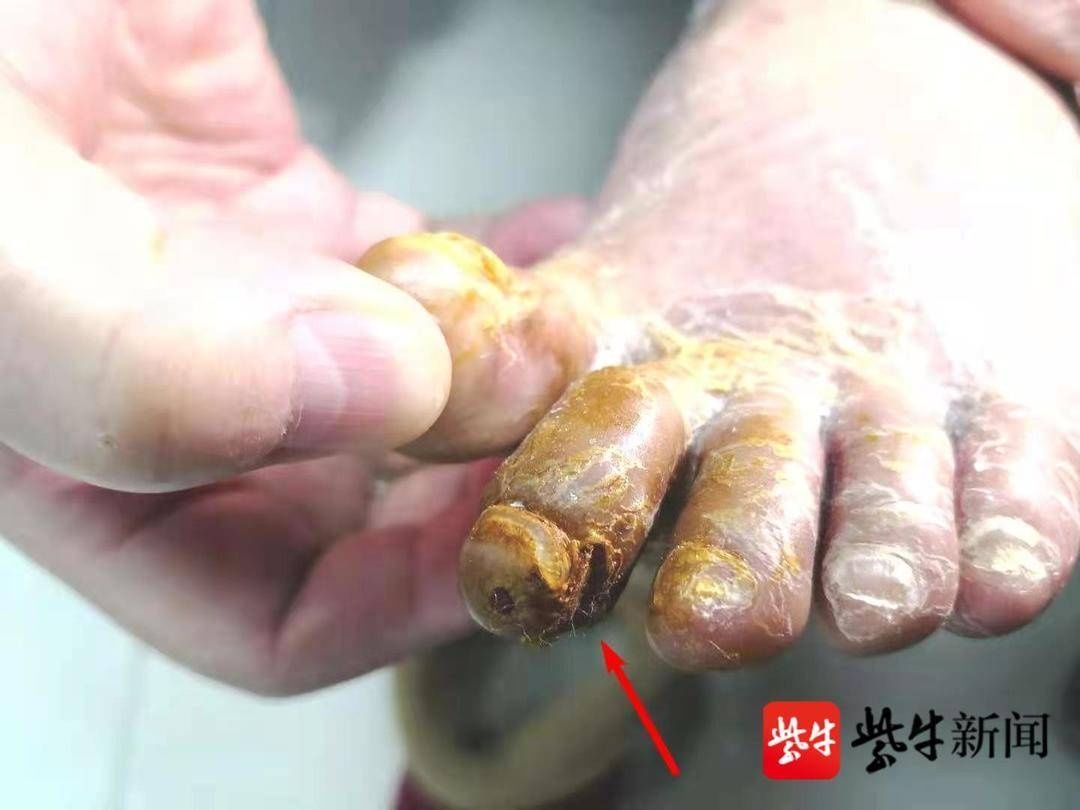  中西医|脚都要烂了！96岁老兵受困糖尿病足，中西医结合治疗让她重新站立