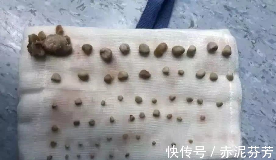 尿血|9岁男孩体内塞了56颗肾结石,只因天天吃这个,很多妈妈还在给孩子喂