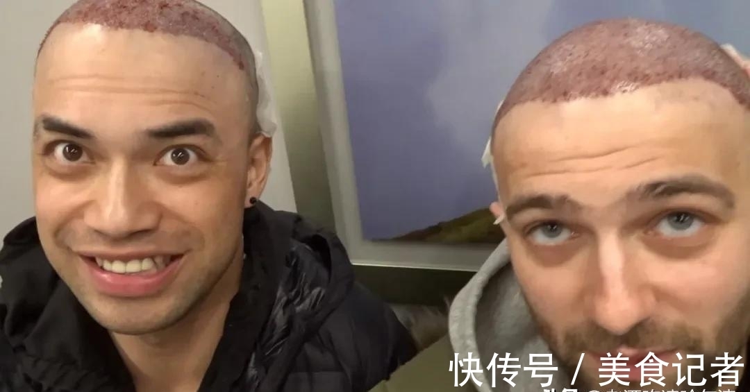 chris 每个月到底有多少人去土耳其植发?