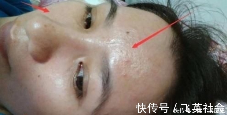 满面|青春期女孩总是“油光满面”?坚持这“3习惯”,摆脱“大油田”!