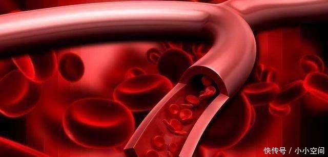 血栓|血管堵了不要慌，多吃这几种食物，清除血管垃圾防血栓