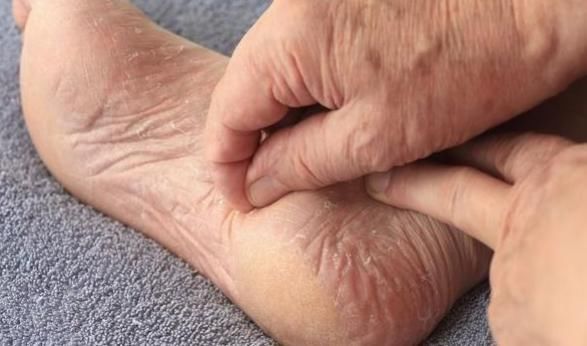 血糖过高|“血糖高足先知”!提醒:脚部若出现3种异常,说明血糖过高了