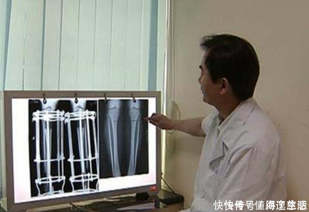 断骨|6年前花16万,断骨增高7.2厘米的男生李亚诺,现在代价来了