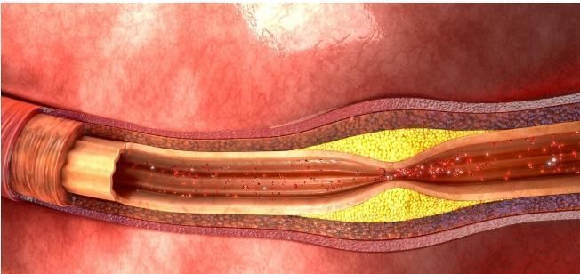 迹象|若双腿出现4个迹象，或是在反复提醒你：血脂高了，切勿忽视