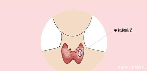 百病|肝气郁结惹百病，送你软坚散结法，疏肝理气化除结节