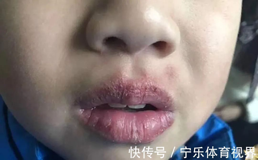 不良习惯|孩子嘴唇干裂、起皮还出血怎么办?医生教你正确护理,比喝水管用